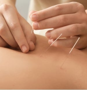 Acupuncture Treatment on patient